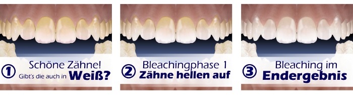 Bleaching - vom Beginn bis zum Resultat
