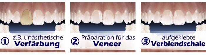 Beispiel f&uuml;r eine Veneerversorgung